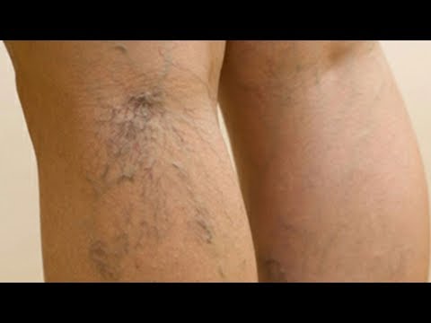 Wie gribok der Nägel auf den Beinen tatsächlich zu heilen Gribok die Häute des Fusses und der Handflächen