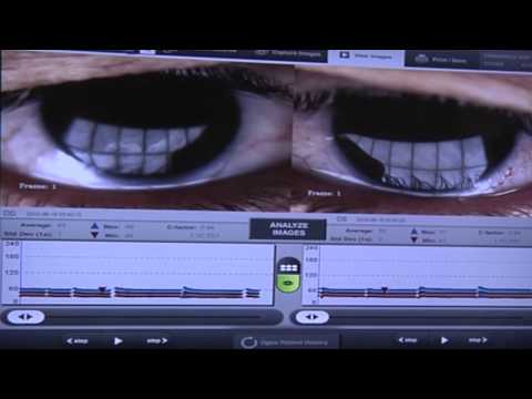 Eric Donnenfeld, MD discuss a Dry Eye Consultation for patients with TearScience technology