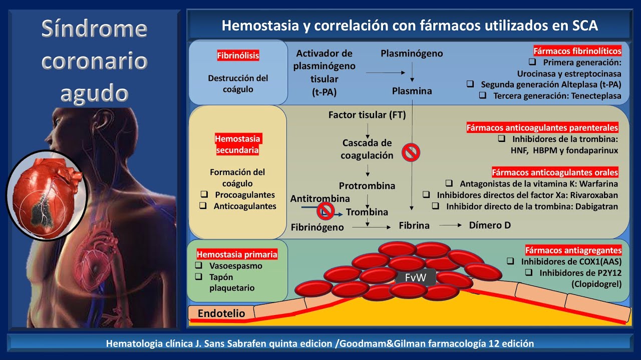 Síndrome coronario agudo: IAMCEST, IAMSEST y angina inestable. #enarm