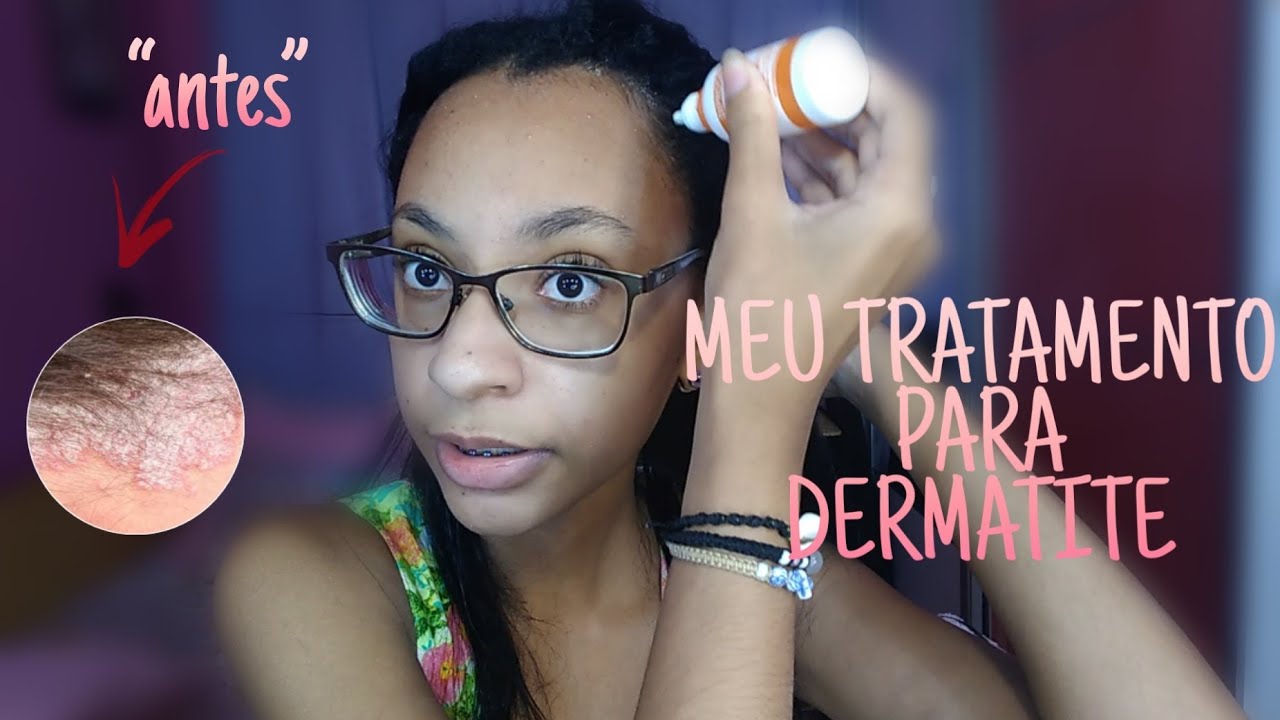 COMO TRATEI MINHA DERMATITE SEBORREICA | PRODUTOS