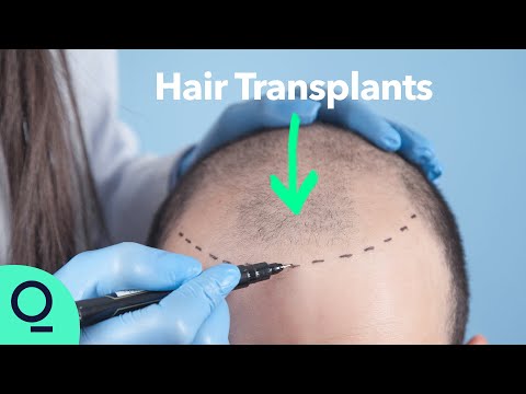 How Istanbul Became A Premier Hair Transplant Destination With An Industry Valuation Of Over One Billion Dollars