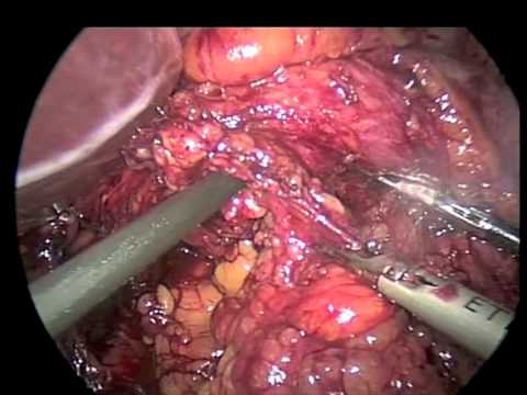 Esofagectomía distal laparoscópica, gastrectomía proximal con reconstrucción en Y de Roux