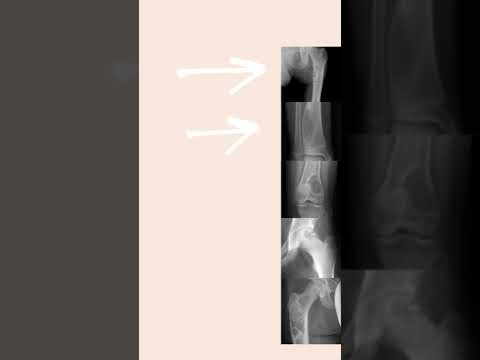A csípőízület deformáló artrózisa 1 fokos kezelés