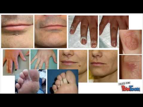 Guia definitiva para diferenciar lunares verrugas y melanoma Guia definitiva para diferenciar lunares verrugas y melanoma