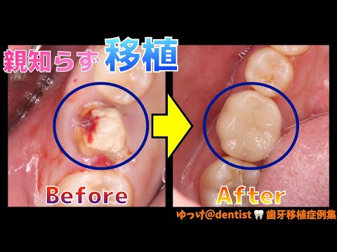 生命歯学科 【歯牙移植症例集】２０代で抜歯と言われた患者さん　保険でできる親知らずを利用した歯の移植法を公開❗️インプラント、ブリッジ、入れ歯に次ぐ第4の治療法「歯の移植」をわかりやすく解説‼️