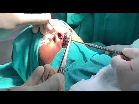 Turkish Delight Nasal Augmentation Graft - A Simple Yet Effective Rhinoplasty Technique