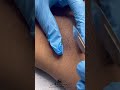 Underarmwhitening Whitening Facialtreatment Skincare Chennai Trending Skincaretips Beauty