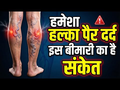 पैरों में हल्का दर्द या भारीपन? ये Varicose Veins का पहला संकेत हो सकता है!