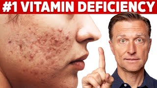 The Top Vitamin Deficiency with Acne