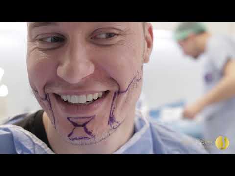 BEARD TRANSPLANTATION IN SOFIA AT BELLISSIMO CLINIC