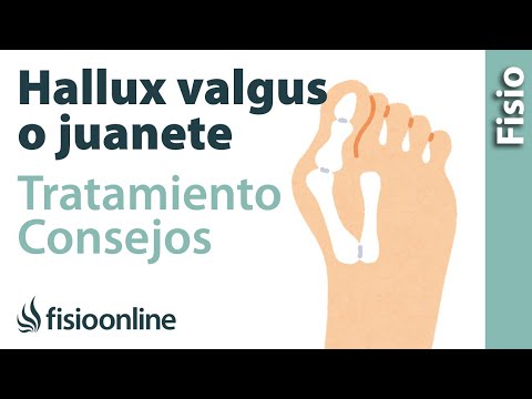 Ejercicios, estiramientos y consejos para tratar los juanetes