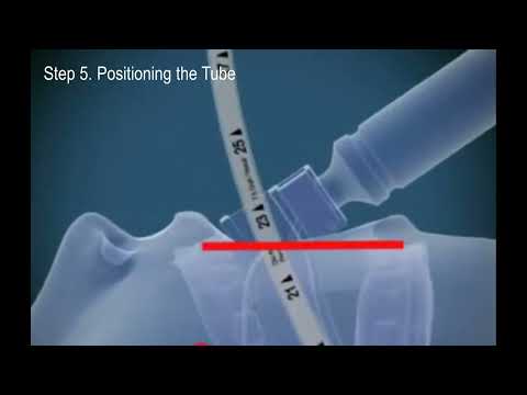 Endotracheal intubation: Step by step procedure