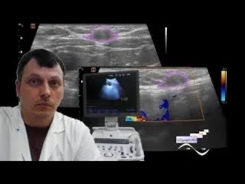 Pediatric Soft tissue ultrasound - Midline neck lesion