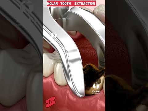 Tooth Extraction 3D Animation #toothextraction #toothdecay