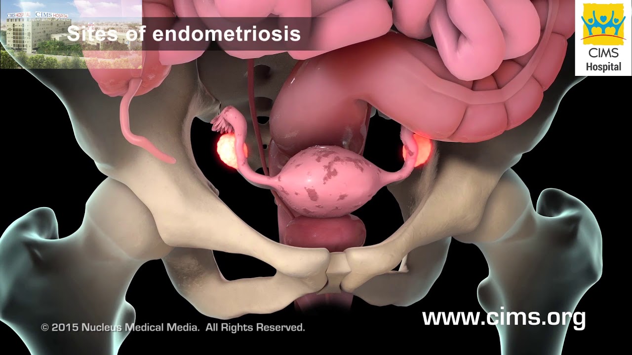 Watch video Endometriosis (Hindi) - CIMS Hospital Now Endometriosis (Hindi) - CIMS Hospital