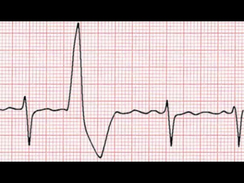 How To Deal With Ectopic Heart Beats (PACs & PVCs)