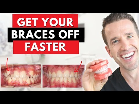 The Secret to Getting Your Braces Off Faster | Dr. Nate