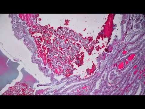 Papiloma in gola