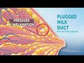 6 Breastfeeding Plugged Milk Ducts