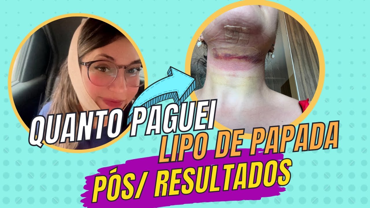 Watch Now Quanto eu paguei na minha lipo de papada / Resultados no Pós Quanto eu paguei na minha lipo de papada / Resultados no Pós