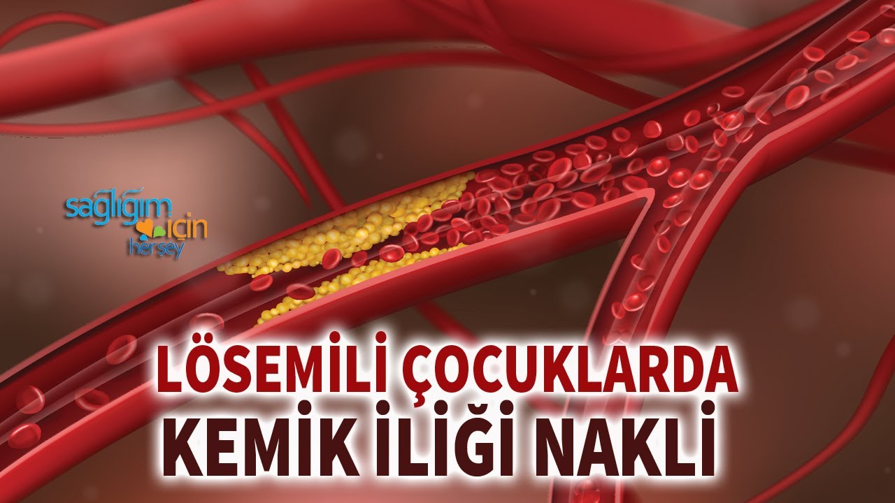 Lösemili Çocuklarda Kemik İliği Nakli