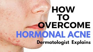 Skin Care Tips- Treating HORMONAL ACNE