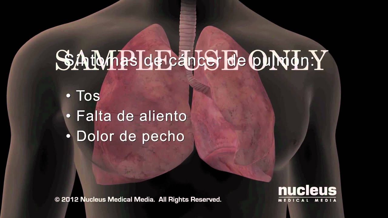 Síntomas del cáncer de pulmón