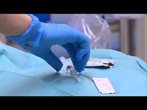 AL SAN JACOPO MENO PAZIENTI RICOVERATI FUORI REPARTO