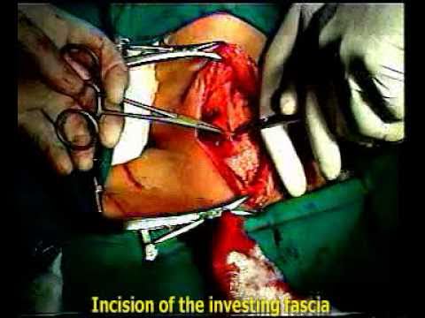 Anatomie Appliquée: Thyroïdectomie Subtotale