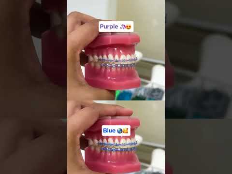 #Braces color that make your teeth look WHITER!