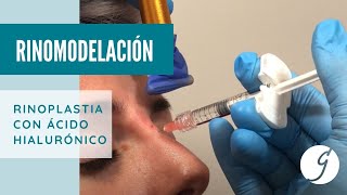 Rinomodelación o rinoplastia líquida  - Dra. Patricia Gutiérrez Ontalvilla