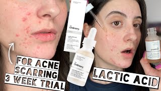 TESTING THE ORDINARY LACTIC ACID 10% + HA ON ACNE SCARS FOR 3 WEEKS | Sensitive + Dry Skin