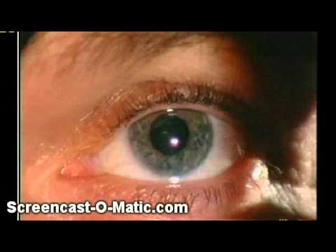 Blindsight - Seeing Without Awareness