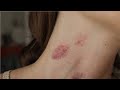 How To Give A Love Bite On The Neck Easy Tutorial