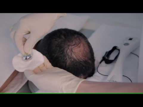 Fusion Mesotherapy - Fractional Meso Hair Treatment