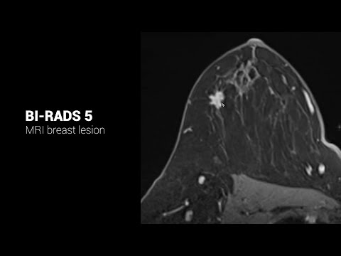 ACR BI-RADS 5 lesion on MRI #TheReportingRoom