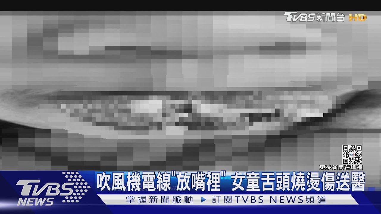 吹風機電線「放嘴裡」 女童舌頭燒燙傷送醫