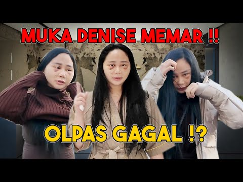 PERUBAHAM MUKA DENISE SETELAH OPLAS !!