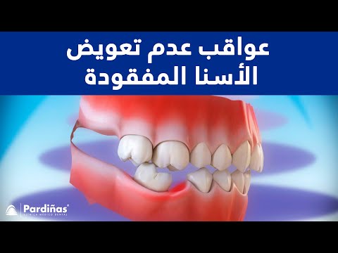 عواقب عدم تعويض الأسنا المفقودة ©