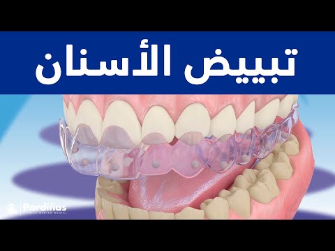 © تبييض الأسنان