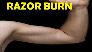 how to get rid of razor burn on armpit naturally