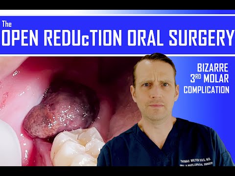 Bizarre Complication After Third Molar Removal | Wisdom Tooth Surgery