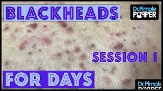 Blackheads for Dayzzzz with Dr Pimple Popper: Session 1