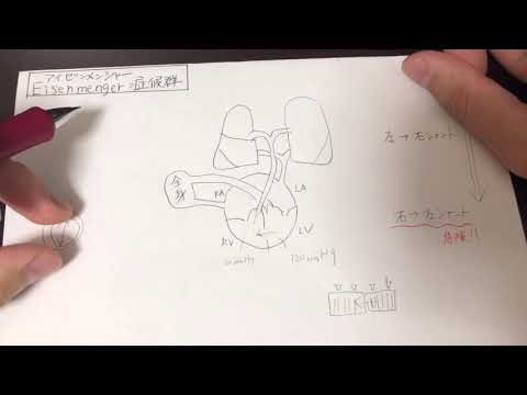 アイゼンメンガー症候群について詳しく解説