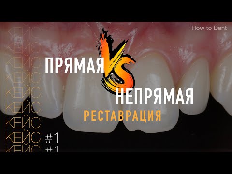 Прямая и непрямая реставрация передних зубов. Как сочетать их вместе? / Кейс #1