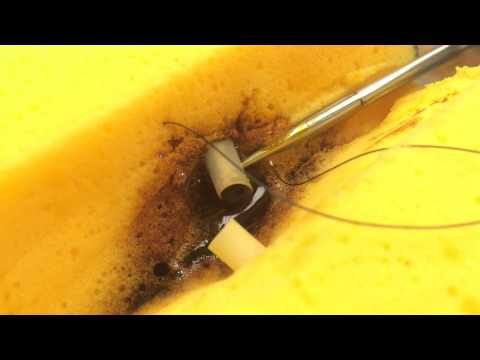 Vascular Ligation: Figure of eight suture