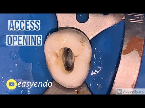 Dostęp endodontyczny do przedtrzonowca szczęki