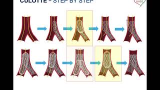 SINERGY 2020 - Bifurcation PCI: lessons from bench testing - Culotte stenting