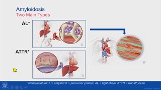 Download Lagu Treatment Update: Medications for Cardiac Amyloidosis Thumbnail