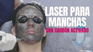 Laser Para Manchas - Hollywood Laser con carbón activado